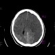 Brain edema, subfalcine herniation: CT - Computed tomography